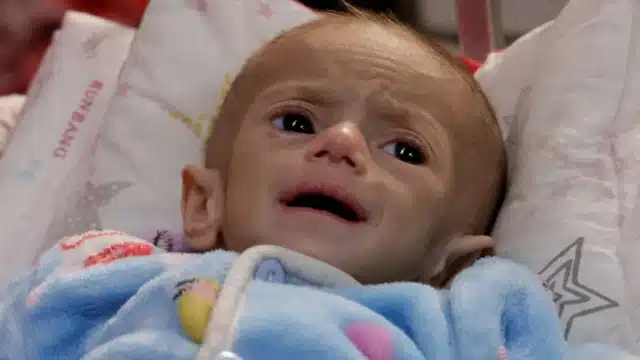 طفل فلسطيني يظهر عليه سوء التغذية