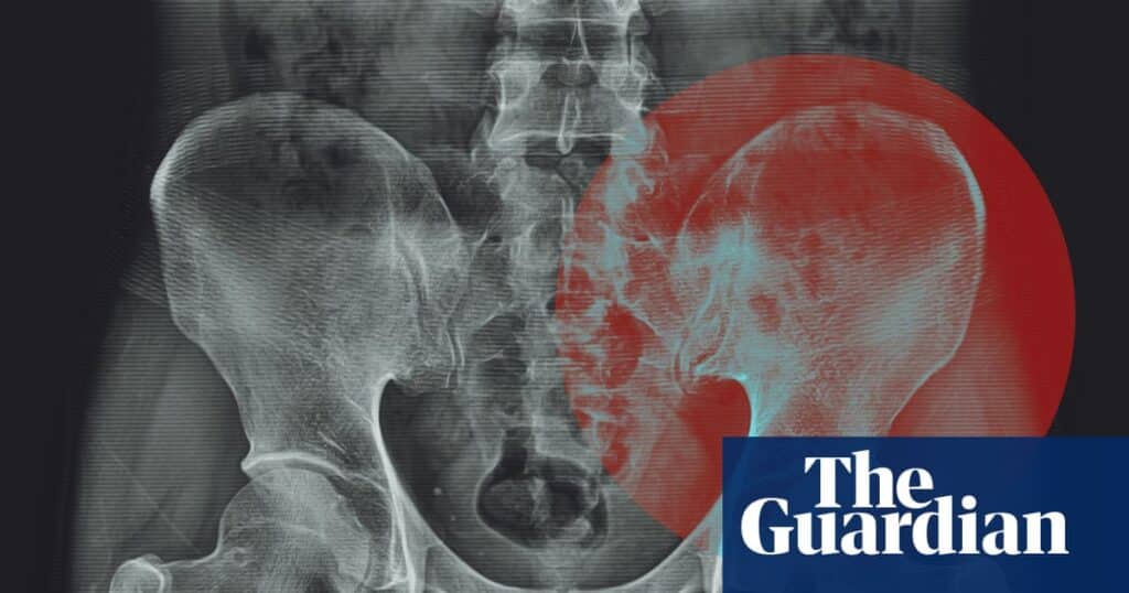 Experts Question Claim That Hips Store Tension