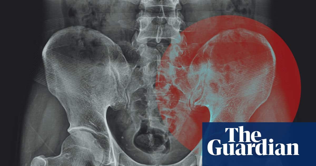 Experts Question Claim That Hips Store Tension