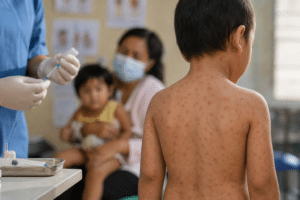 Measles and Diphtheria Cases Raise Health Concerns